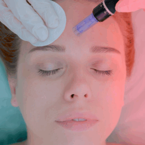 BB Glow + Microneedling