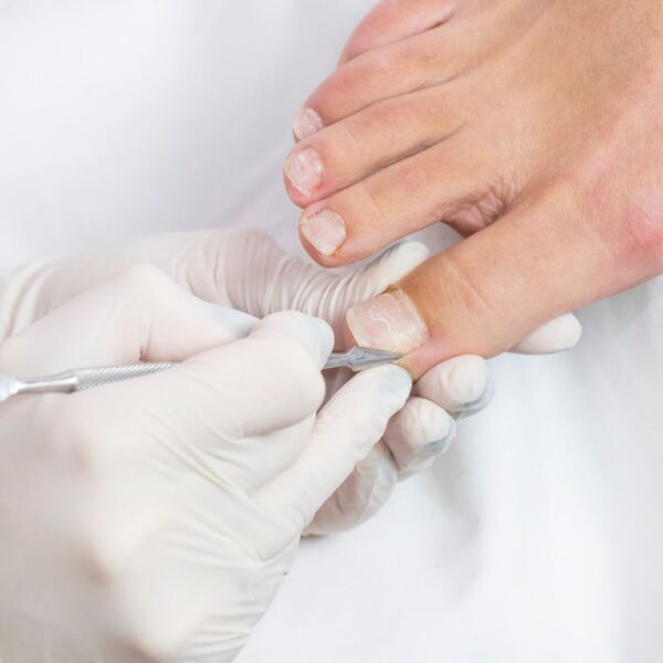 Promo 3+1 Pedicure Curativo